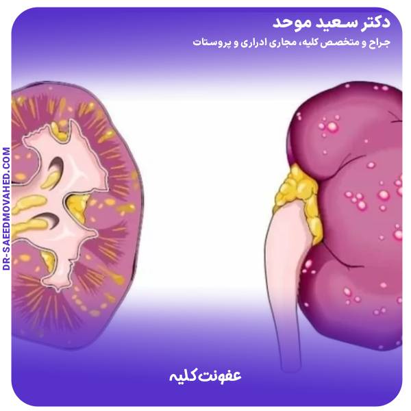 عفونت کلیه