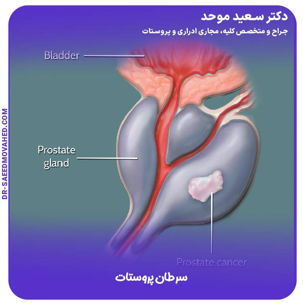 سرطان پروستات