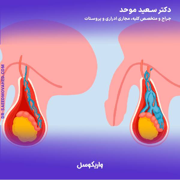 واریکوسل
