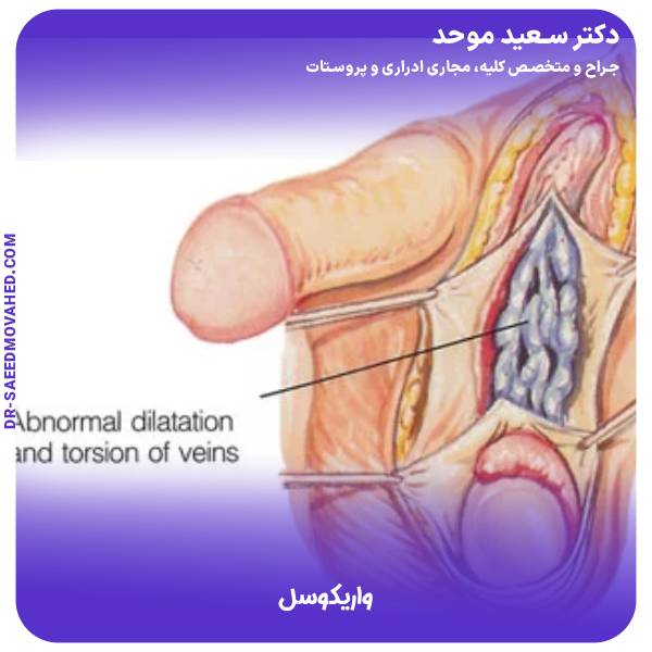 واریکوسل